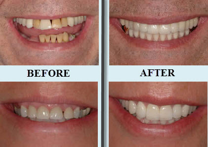 Dental Implants