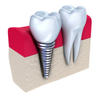 Montgomery dental implants