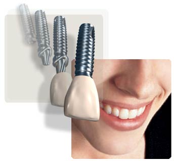 multiple tooth implant