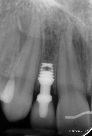 X-Ray of Single Tooth Implant