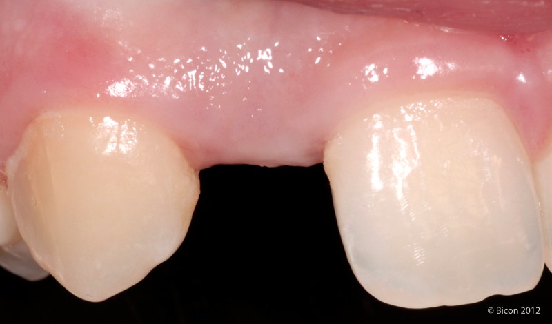 Site Prior to Single Tooth Dental Implant