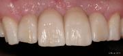 completed multiple tooth implants