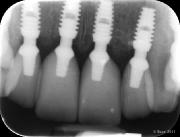 multiple dental implant x-ray