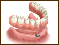 choose dental implants over affordable dentures