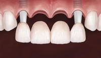 multiple tooth dental implants