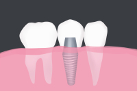 Montgomery Dental Implants