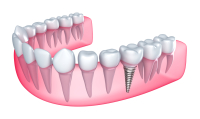 dental implant jawbone location